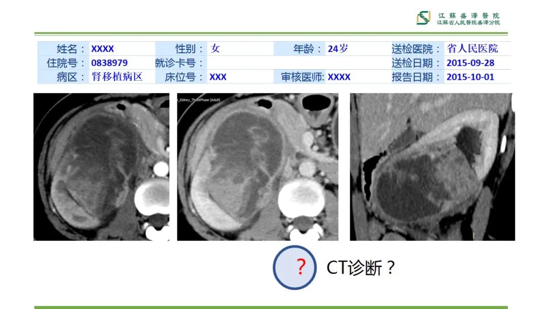 【PPT】肾脏实性肿瘤的良恶性鉴别--影像诊断思路分析-18