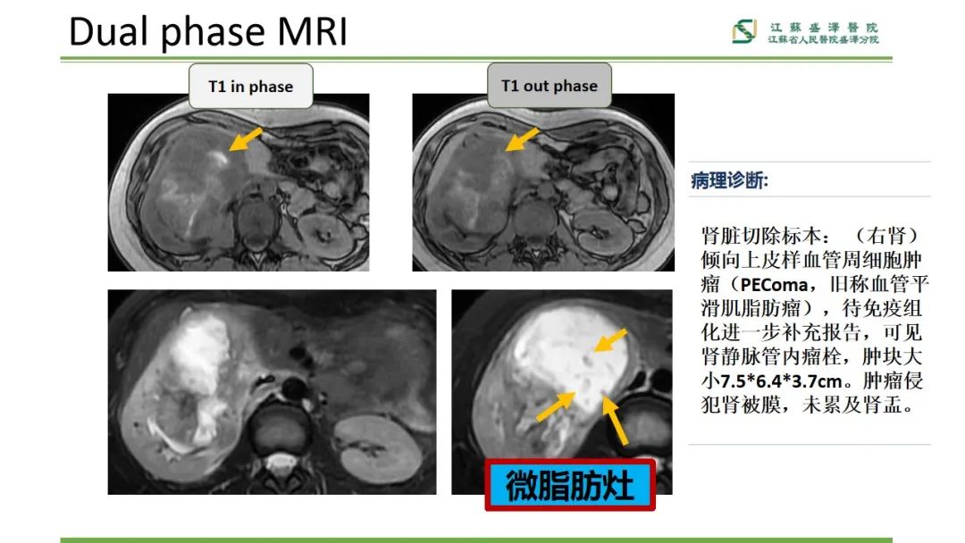 【PPT】肾脏实性肿瘤的良恶性鉴别--影像诊断思路分析-19