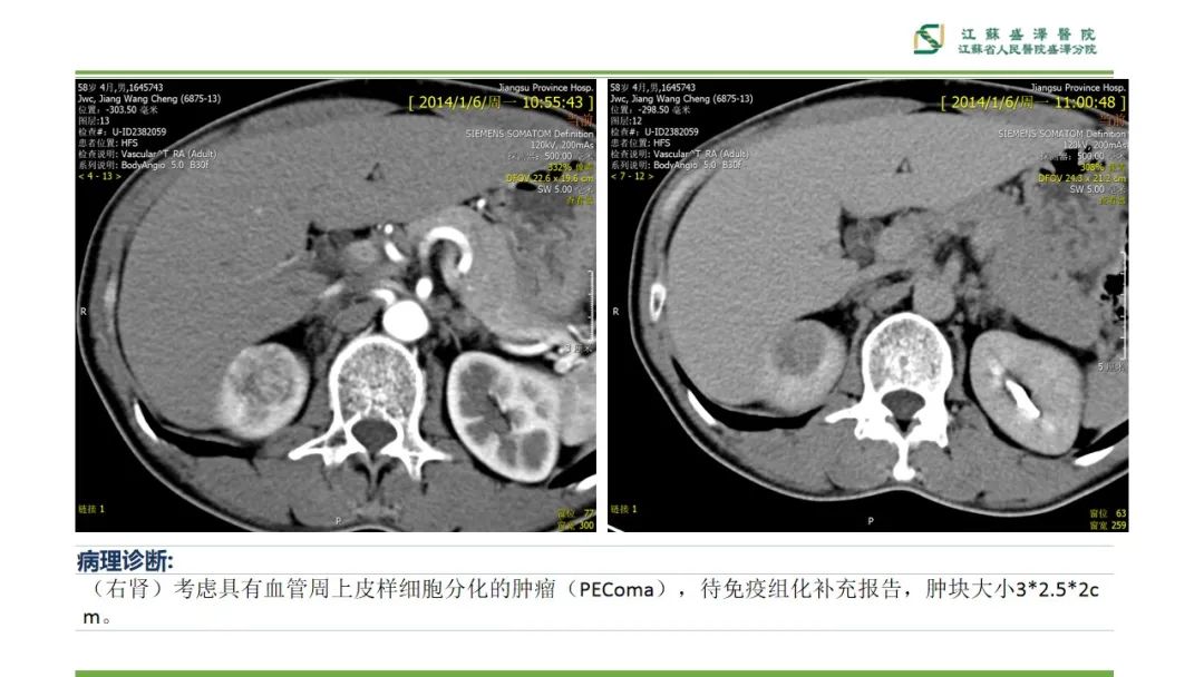 【PPT】肾脏实性肿瘤的良恶性鉴别--影像诊断思路分析-23