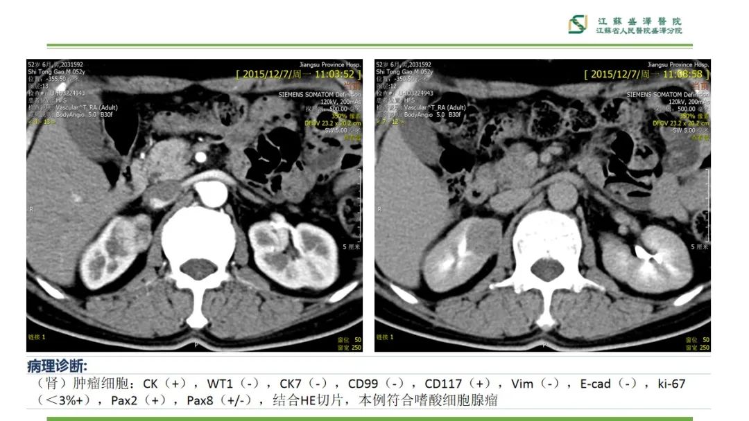 【PPT】肾脏实性肿瘤的良恶性鉴别--影像诊断思路分析-20