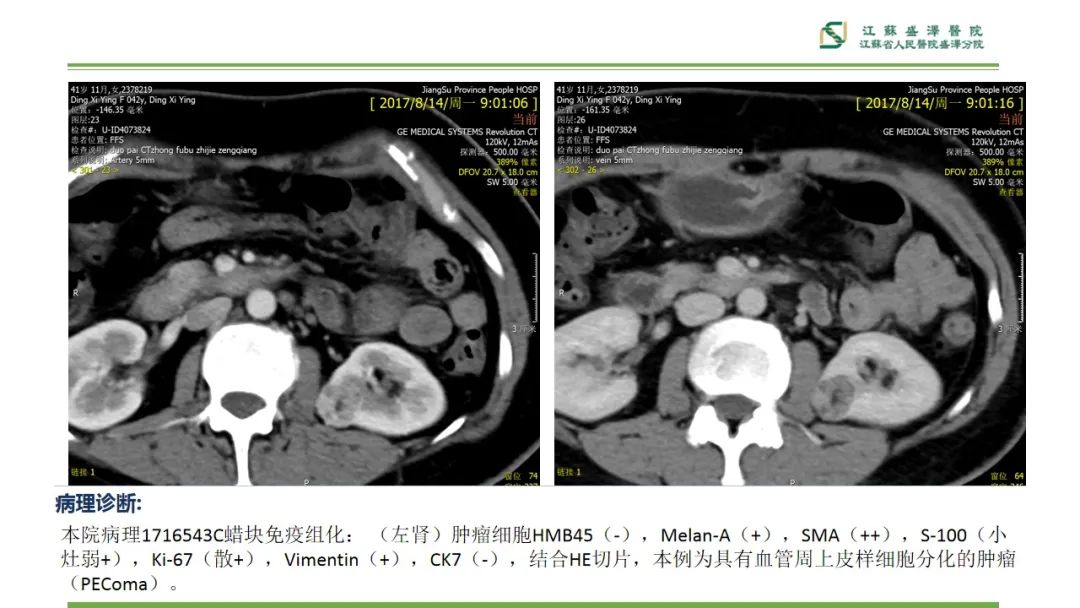 【PPT】肾脏实性肿瘤的良恶性鉴别--影像诊断思路分析-21