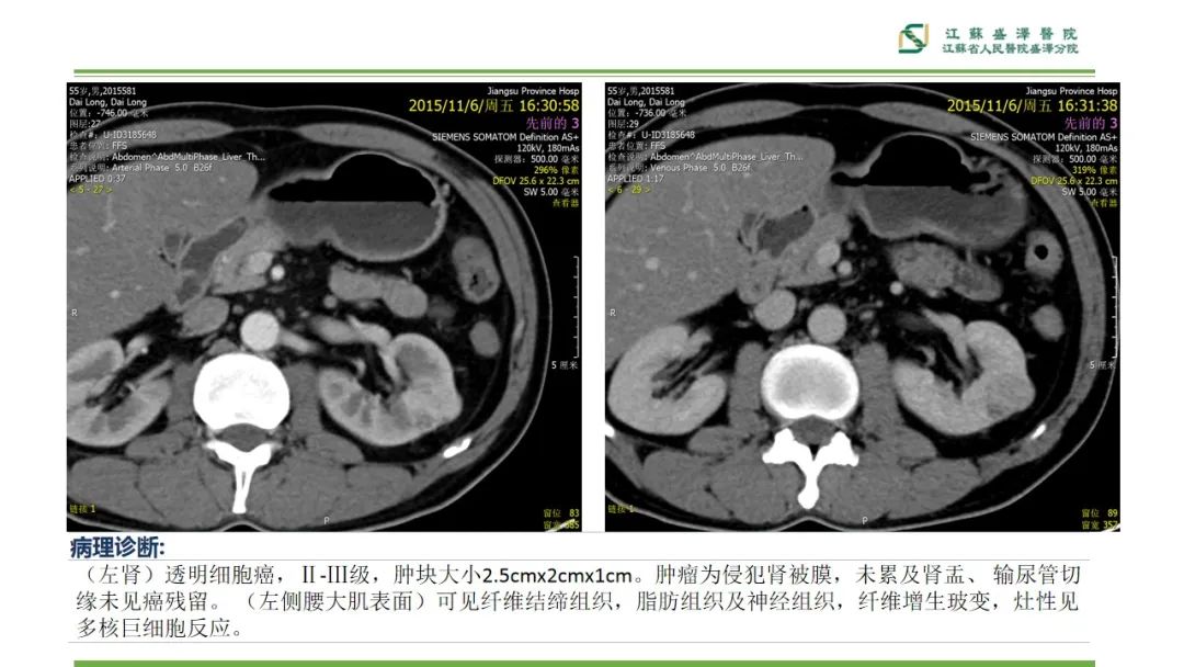 【PPT】肾脏实性肿瘤的良恶性鉴别--影像诊断思路分析-22