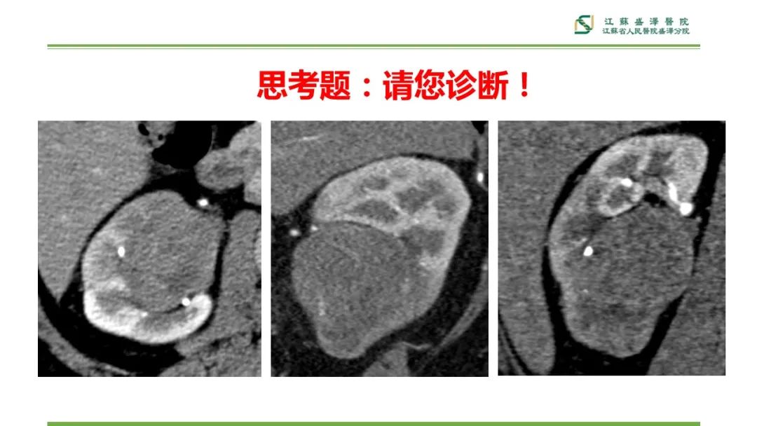 【PPT】肾脏实性肿瘤的良恶性鉴别--影像诊断思路分析-25