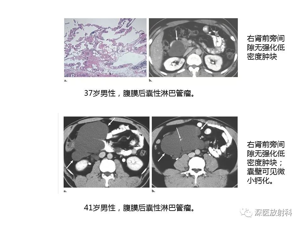【PPT】原发性腹膜后囊性病变影像学特征-6