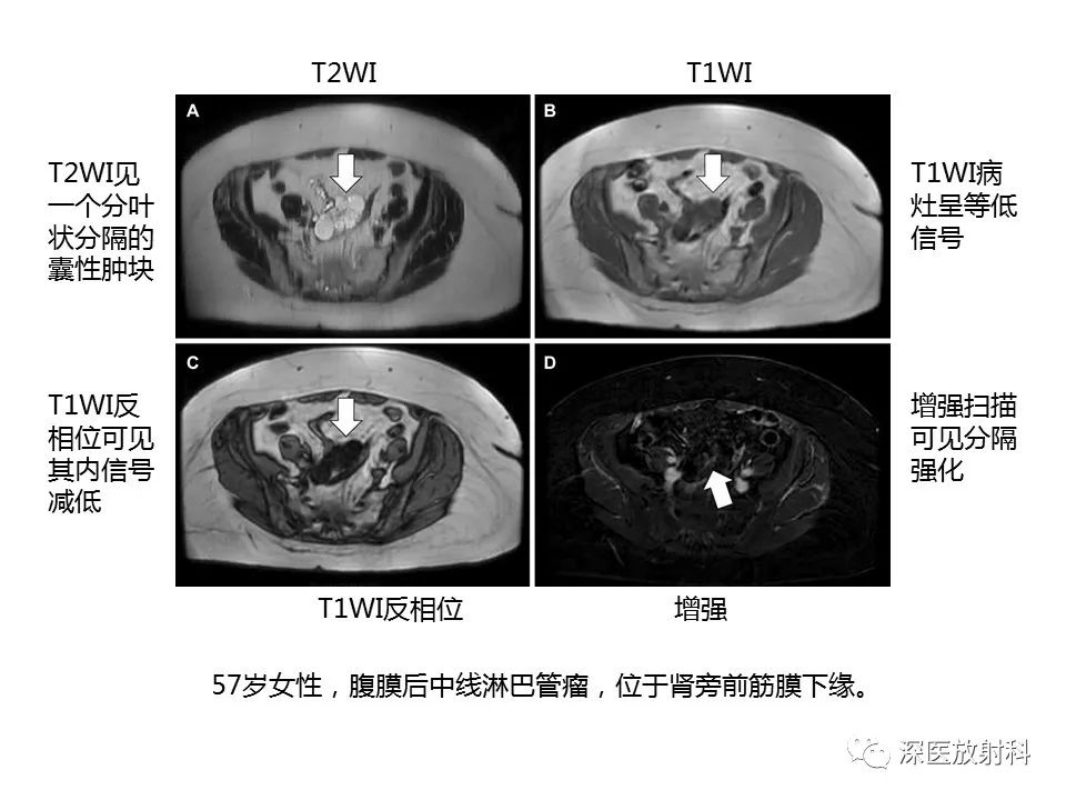 【PPT】原发性腹膜后囊性病变影像学特征-7