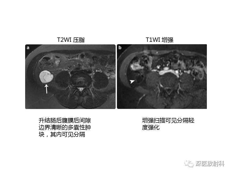 【PPT】原发性腹膜后囊性病变影像学特征-10