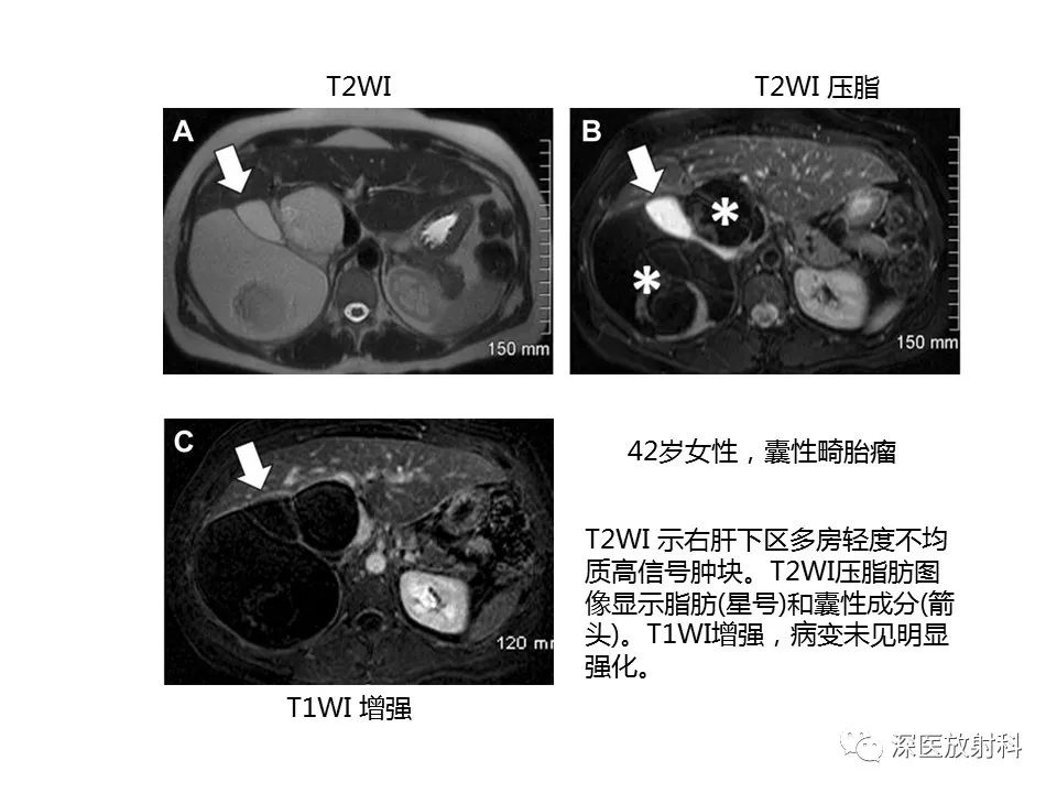 【PPT】原发性腹膜后囊性病变影像学特征-12