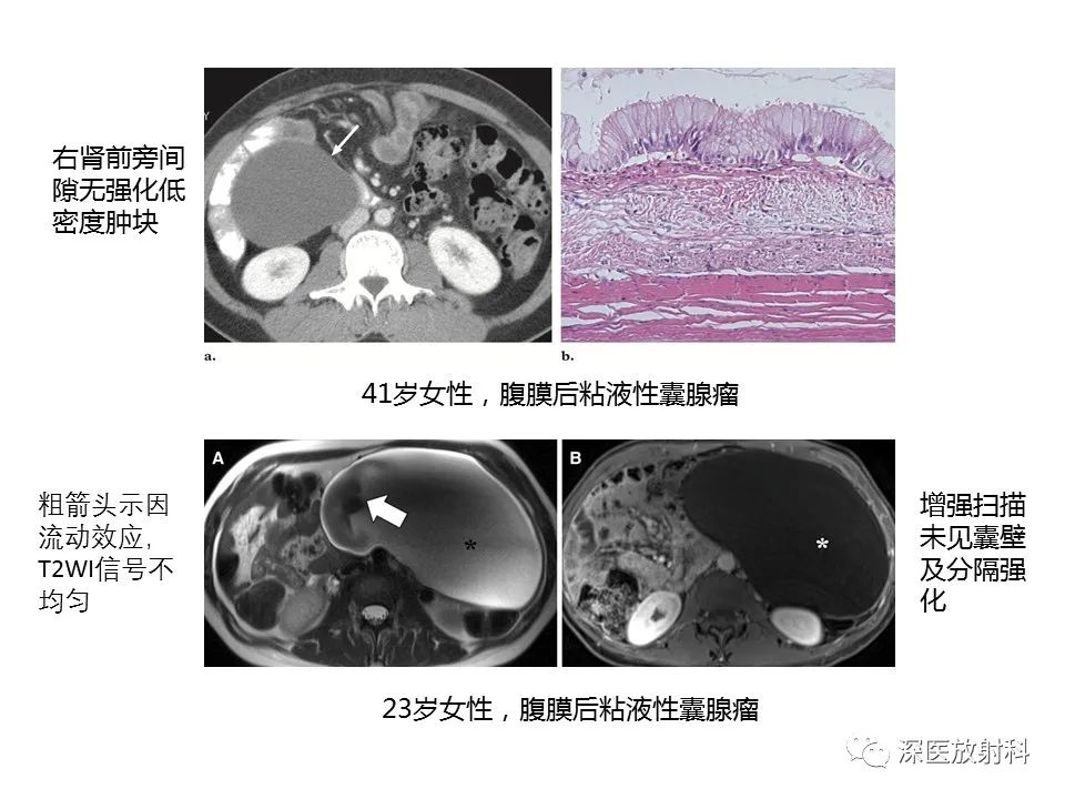【PPT】原发性腹膜后囊性病变影像学特征-9
