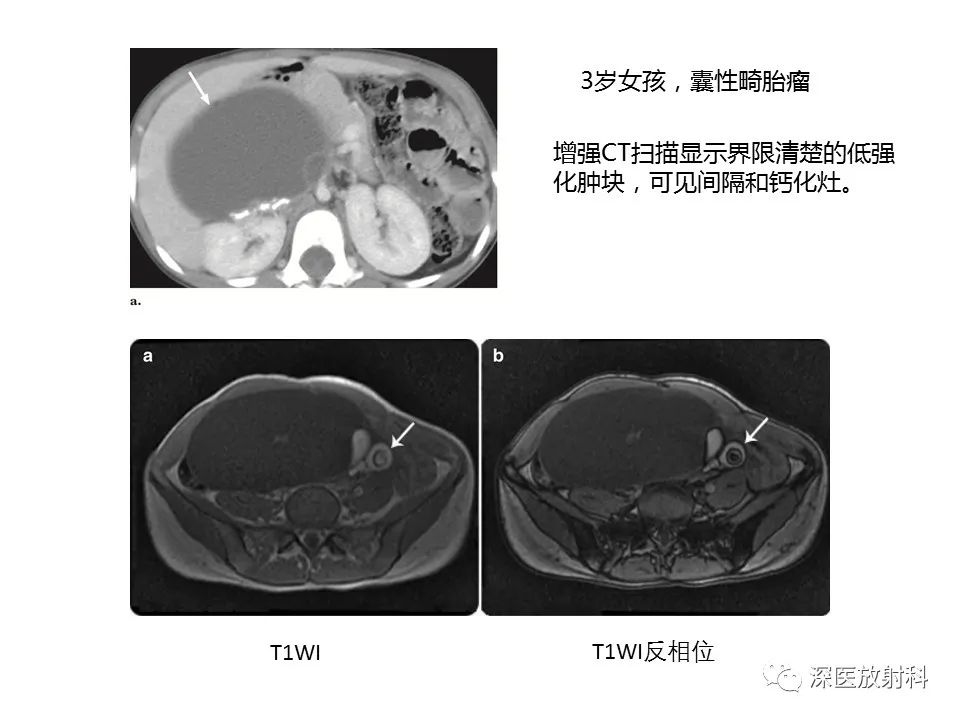【PPT】原发性腹膜后囊性病变影像学特征-13