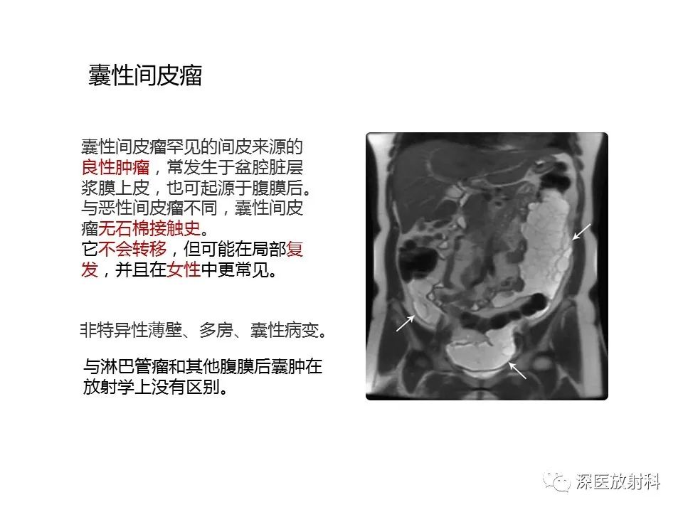 【PPT】原发性腹膜后囊性病变影像学特征-14