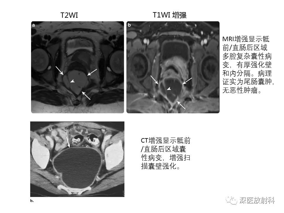 【PPT】原发性腹膜后囊性病变影像学特征-16