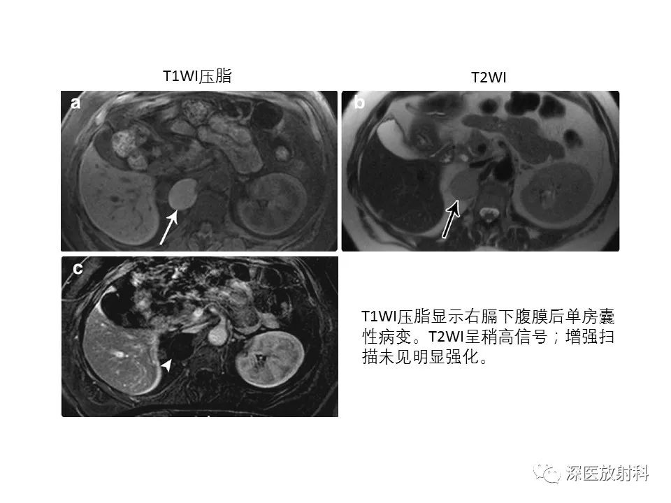 【PPT】原发性腹膜后囊性病变影像学特征-18
