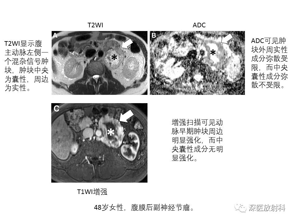 【PPT】原发性腹膜后囊性病变影像学特征-21