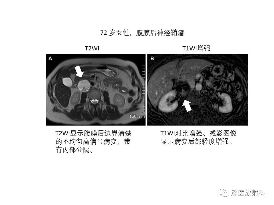 【PPT】原发性腹膜后囊性病变影像学特征-23