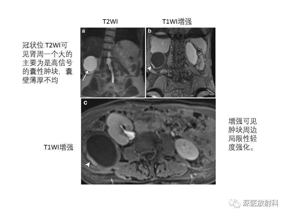 【PPT】原发性腹膜后囊性病变影像学特征-24