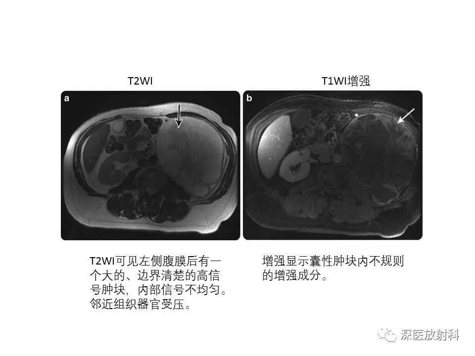【PPT】原发性腹膜后囊性病变影像学特征-26
