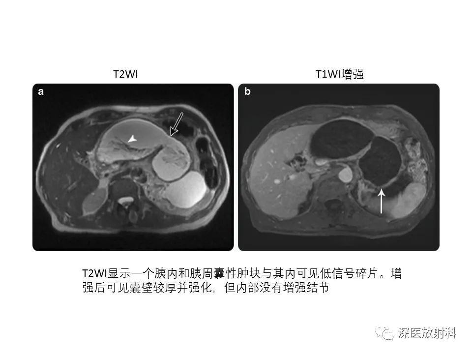 【PPT】原发性腹膜后囊性病变影像学特征-30