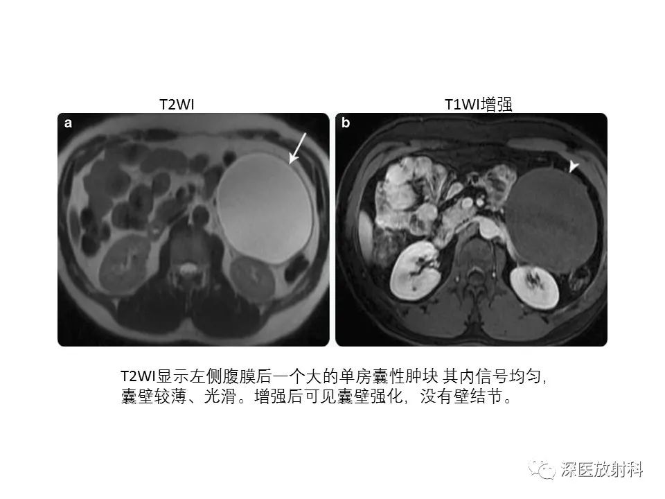 【PPT】原发性腹膜后囊性病变影像学特征-32