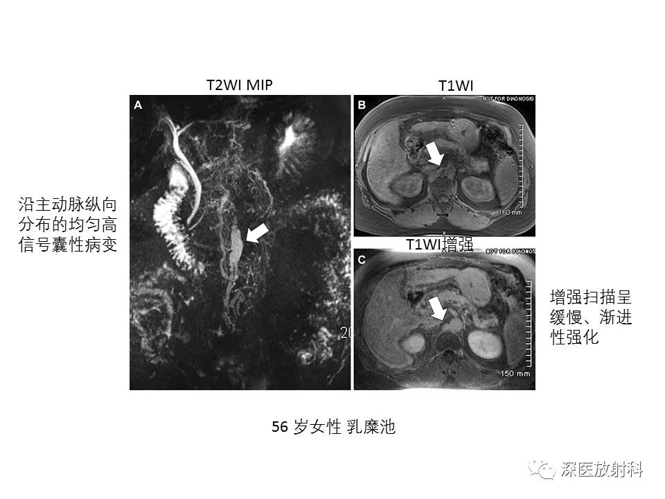 【PPT】原发性腹膜后囊性病变影像学特征-34