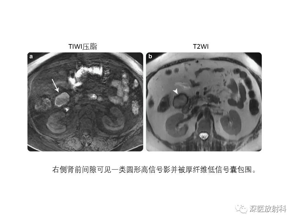 【PPT】原发性腹膜后囊性病变影像学特征-36