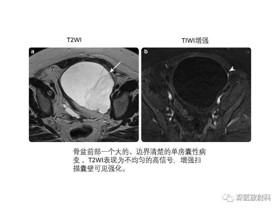 【PPT】原发性腹膜后囊性病变影像学特征-39