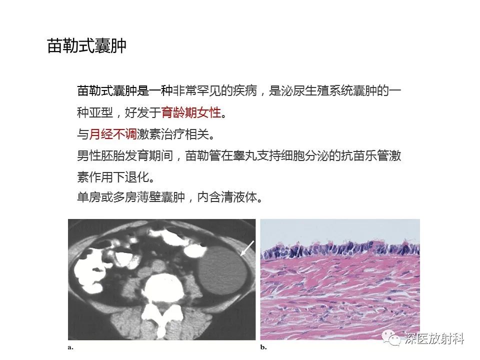 【PPT】原发性腹膜后囊性病变影像学特征-40