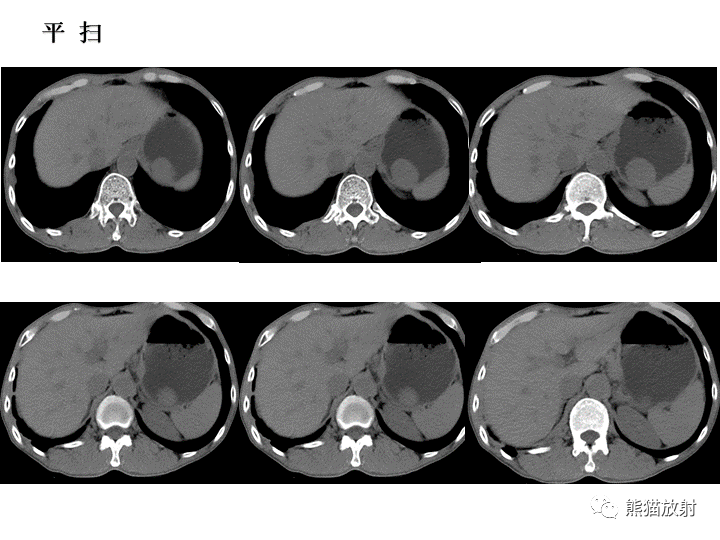 【病例】胃间质瘤VS神经鞘瘤-3