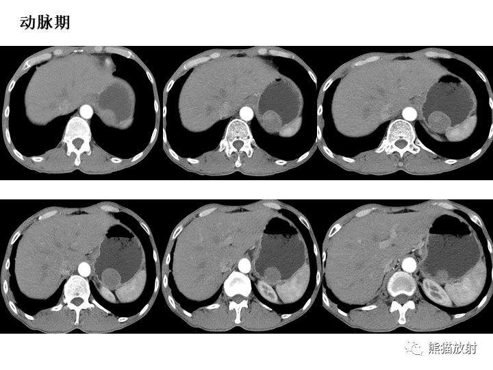 【病例】胃间质瘤VS神经鞘瘤-4