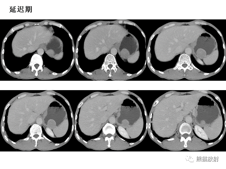 【病例】胃间质瘤VS神经鞘瘤-6