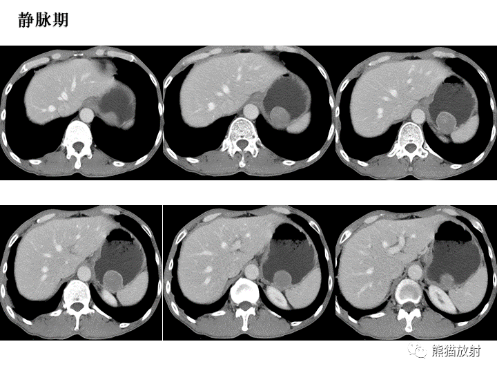 【病例】胃间质瘤VS神经鞘瘤-5