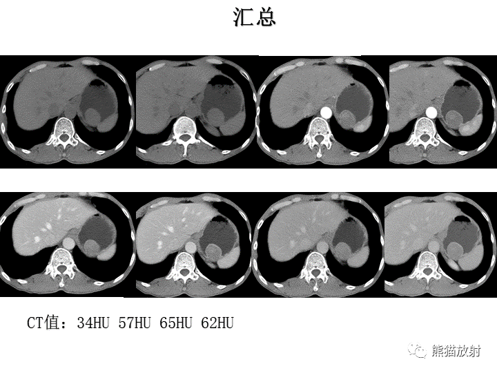 【病例】胃间质瘤VS神经鞘瘤-7