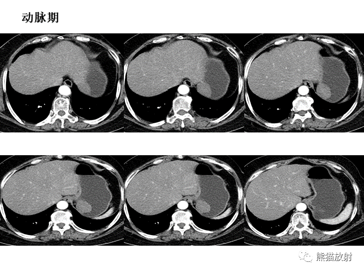 【病例】胃间质瘤VS神经鞘瘤-11