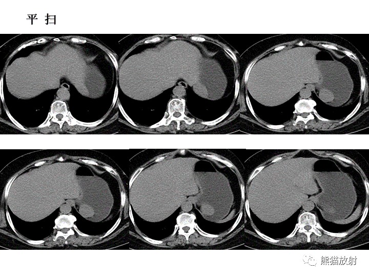 【病例】胃间质瘤VS神经鞘瘤-10