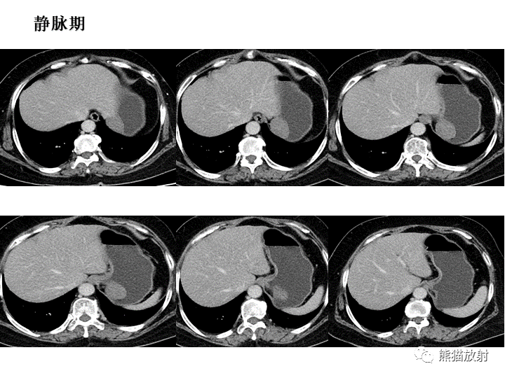 【病例】胃间质瘤VS神经鞘瘤-12