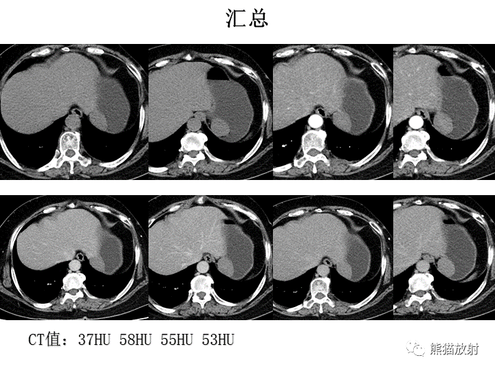 【病例】胃间质瘤VS神经鞘瘤-14