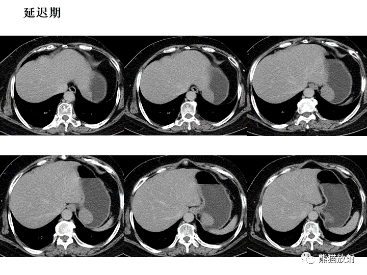 【病例】胃间质瘤VS神经鞘瘤-13
