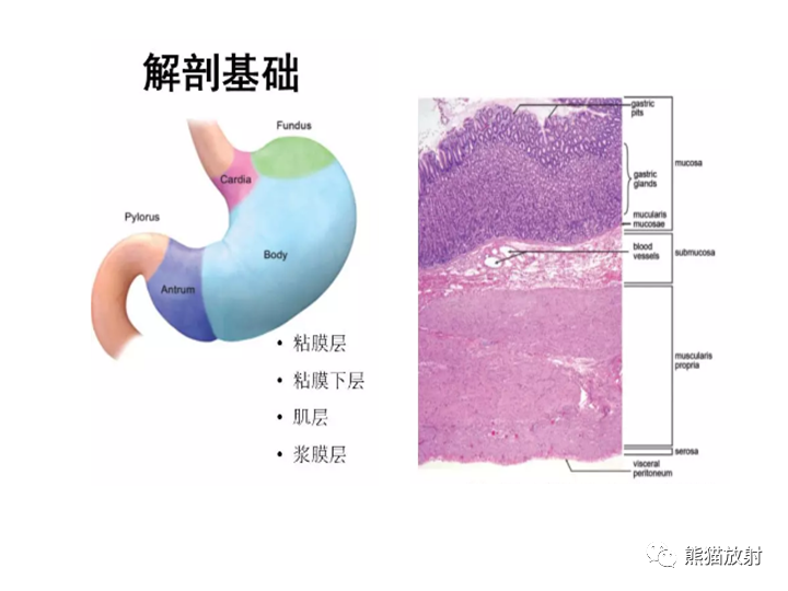 【病例】胃间质瘤VS神经鞘瘤-17