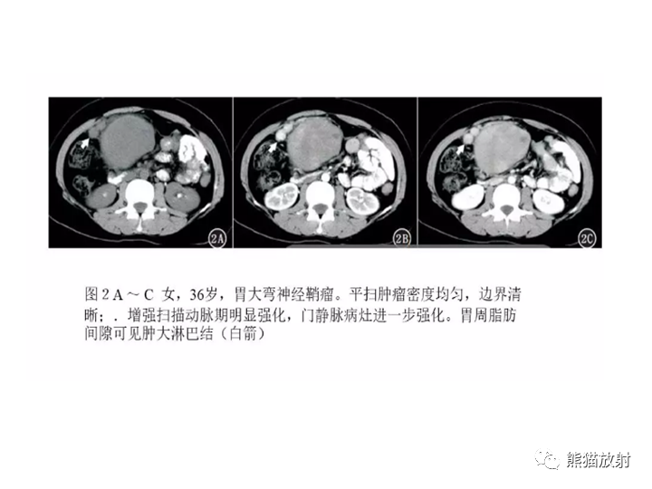 【病例】胃间质瘤VS神经鞘瘤-21