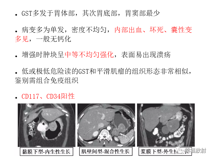 【病例】胃间质瘤VS神经鞘瘤-23