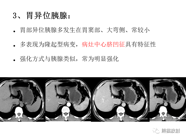 【病例】胃间质瘤VS神经鞘瘤-25