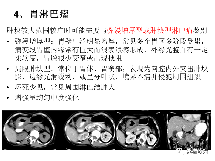 【病例】胃间质瘤VS神经鞘瘤-26