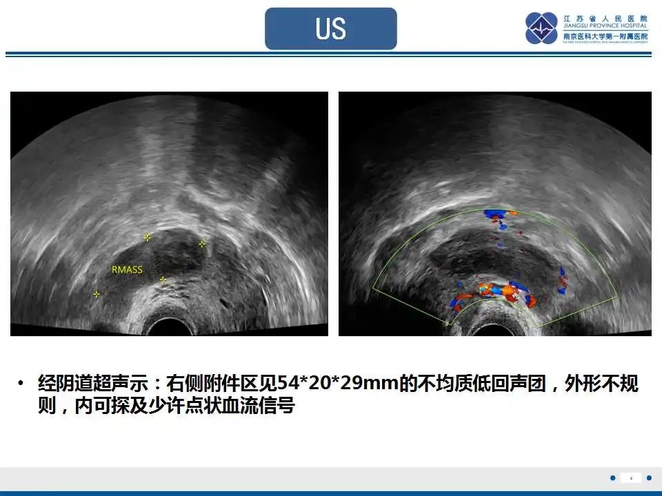 【PPT】原发性输卵管癌-3