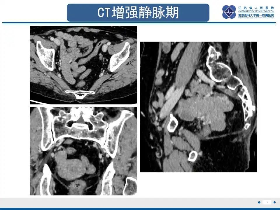 【PPT】原发性输卵管癌-4