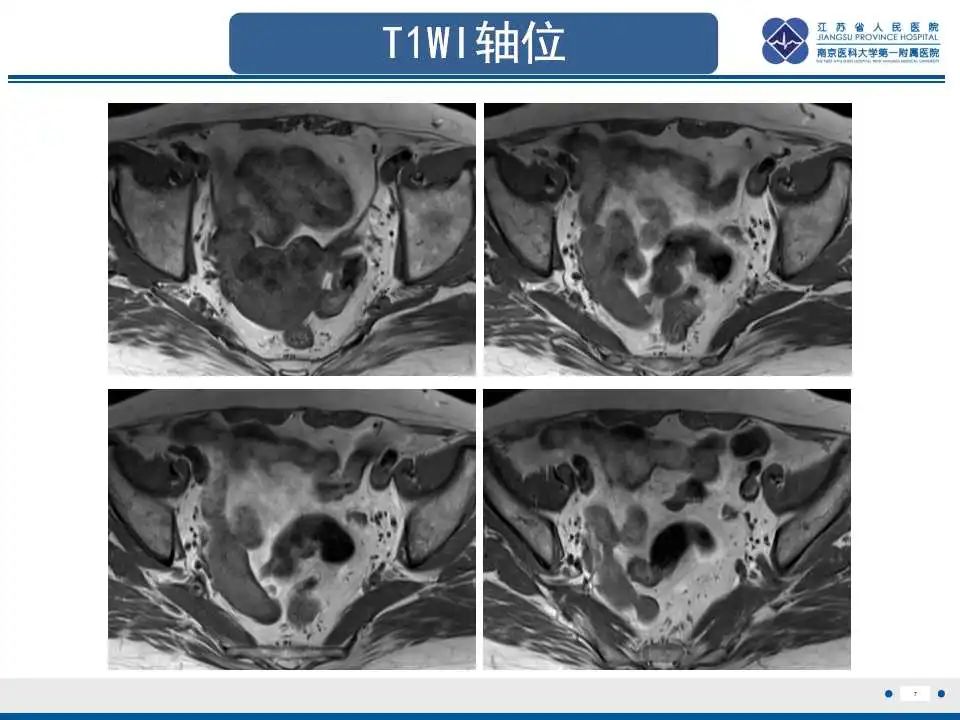【PPT】原发性输卵管癌-8