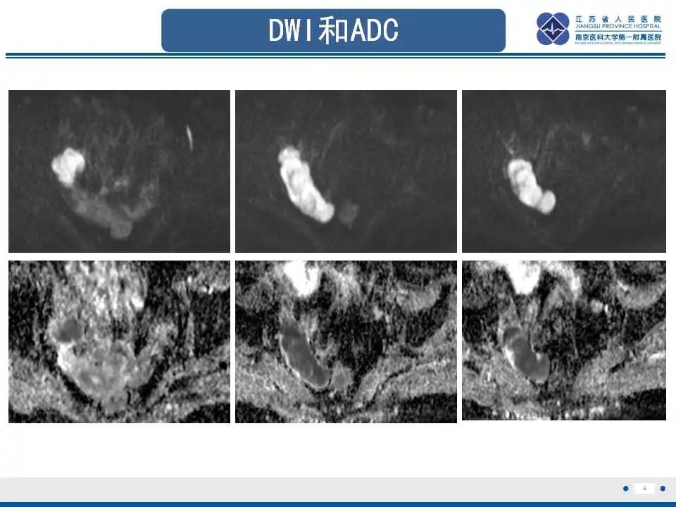 【PPT】原发性输卵管癌-9