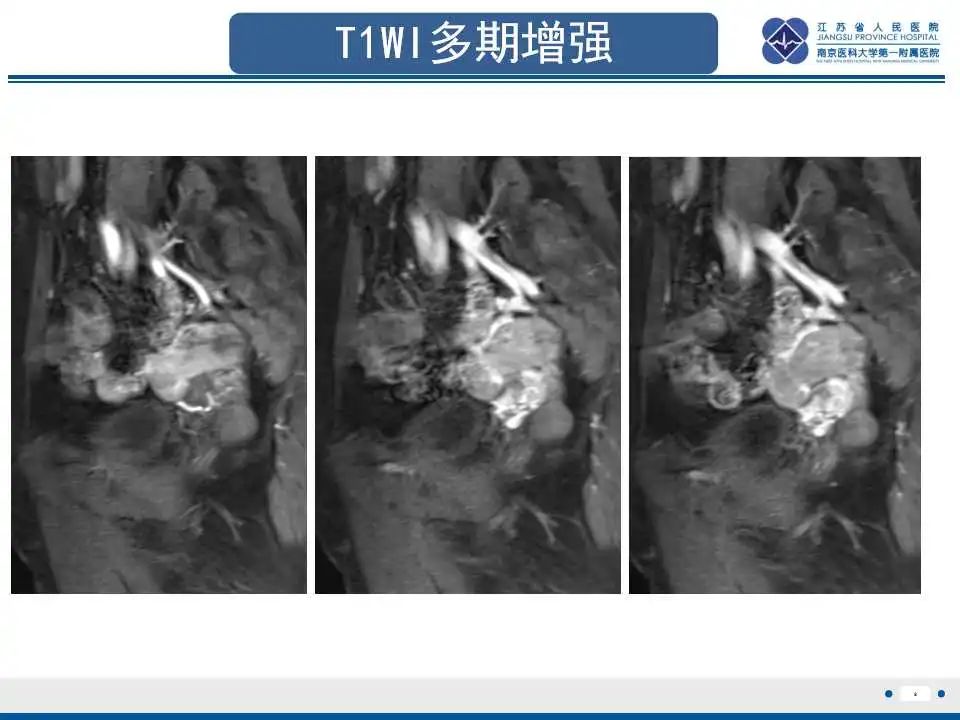 【PPT】原发性输卵管癌-10
