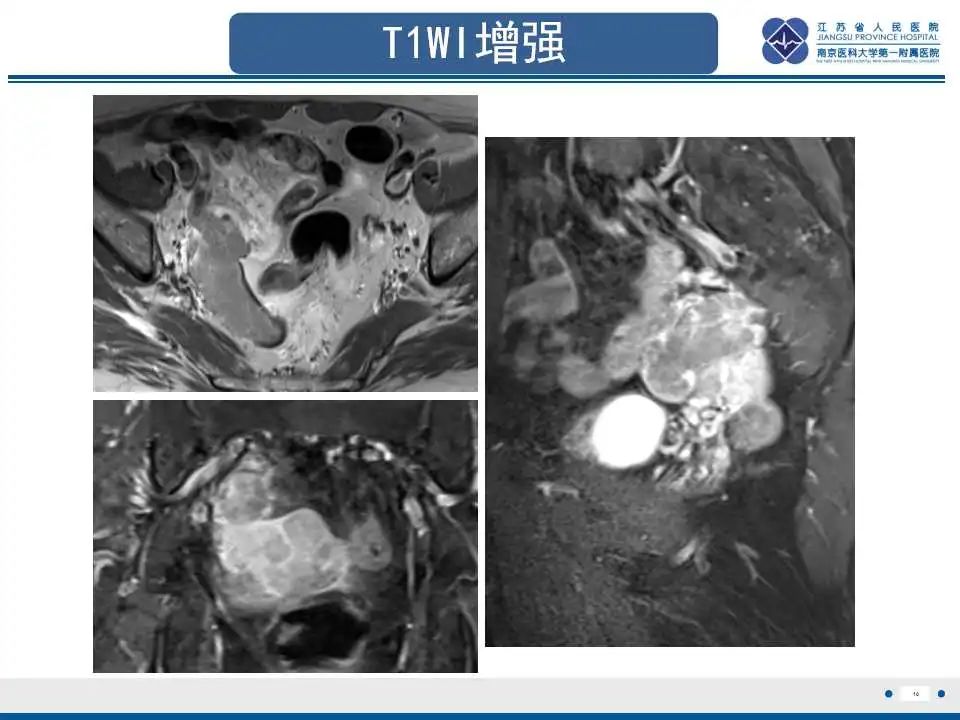 【PPT】原发性输卵管癌-11