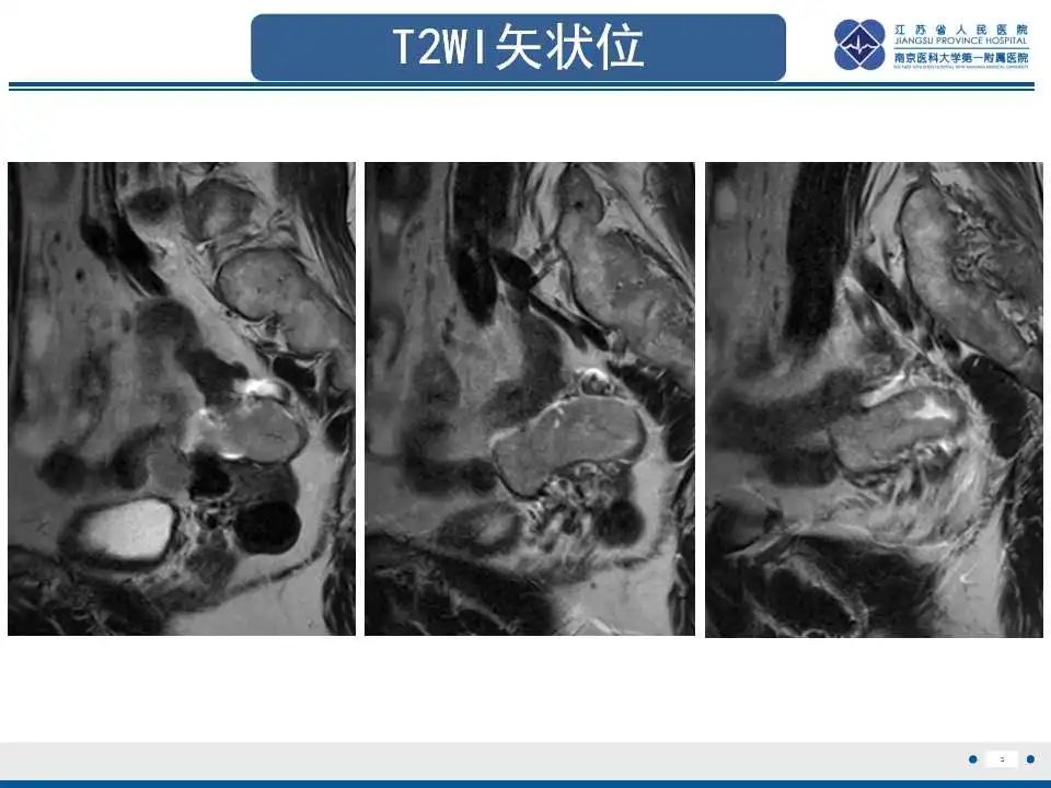 【PPT】原发性输卵管癌-6