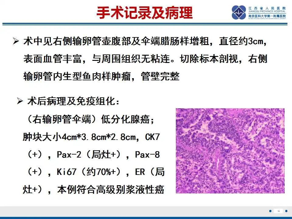 【PPT】原发性输卵管癌-19