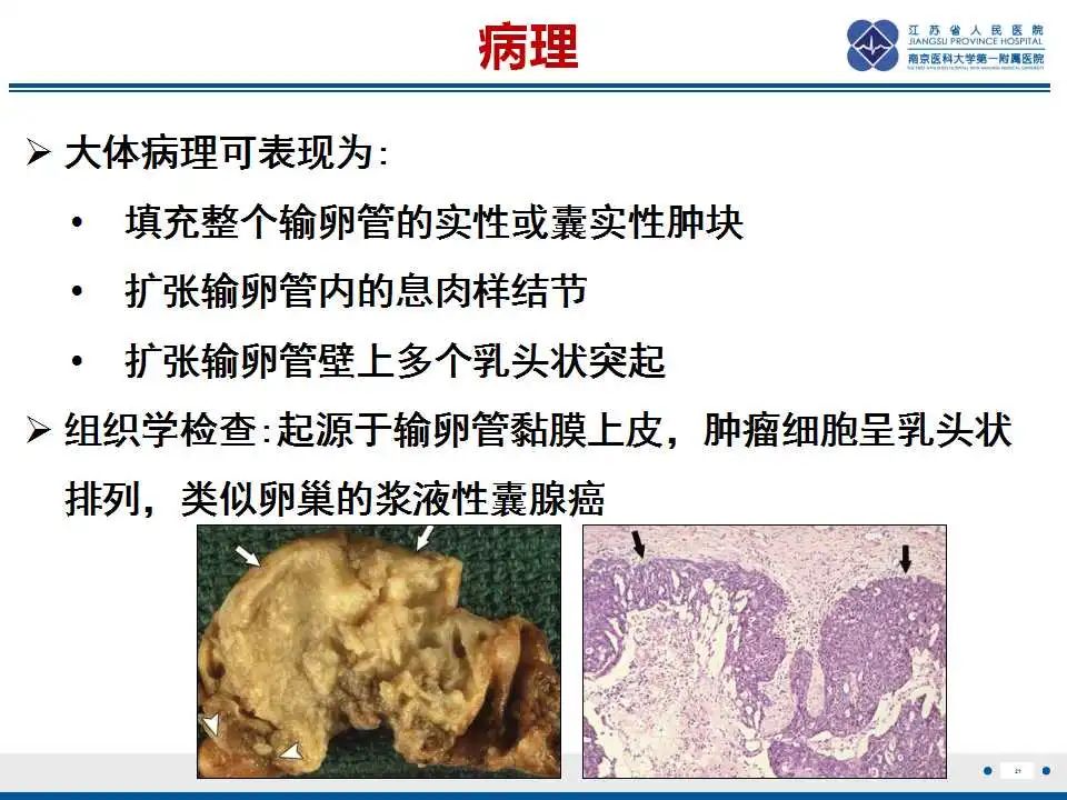 【PPT】原发性输卵管癌-22